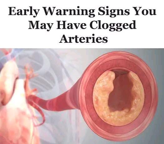 Early Symptoms of Blocked Arteries Explained