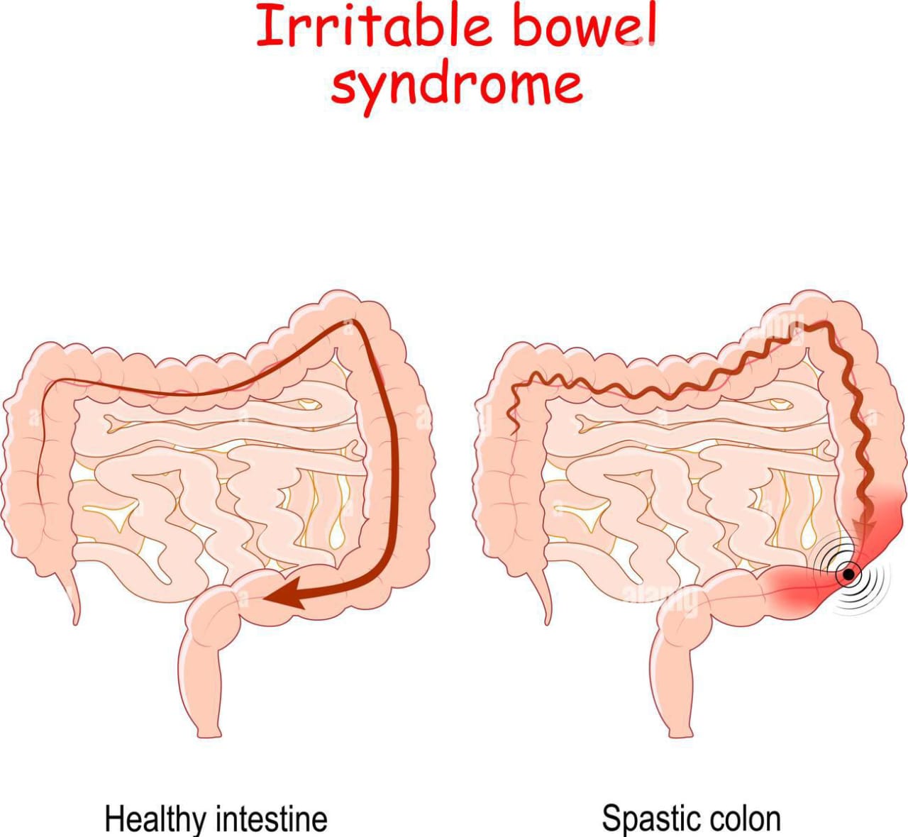 Irritable Bowel Syndrome Symptoms & Causes